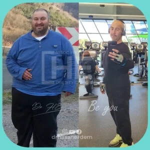 gastric sleeve before after