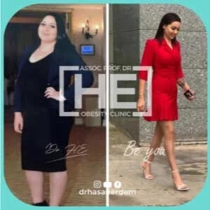 gastric bypass before after