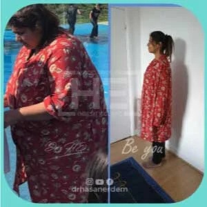 gastric sleeve before after 2